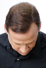 toppik mann 152 mit haarverdichtung