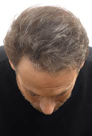 Toppik Mann ohne Effekt 101a