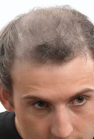 toppik mann 221 ohne haarverdichtung
