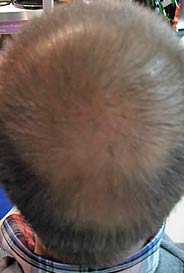 toppik mann 251 mit lichten haaren
