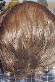 toppik mann 55 mit optischer haarverdichtung