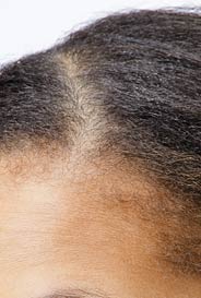 Toppik Damen ohne Anwendung der Haarverdichtung 121