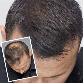 Preview: Toppik Tester Set 12g inkl. Fixier +UV 50ml Preview: Toppik Tester Ergebnis Mann