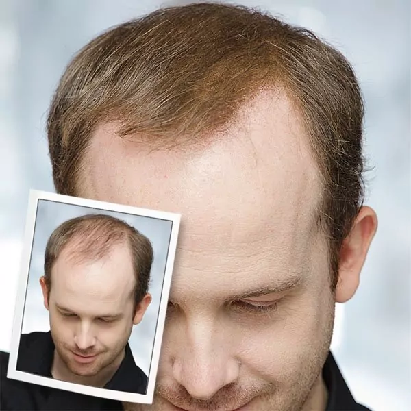 Anwendung Mann vor und nach Toppik Haarverdichtung