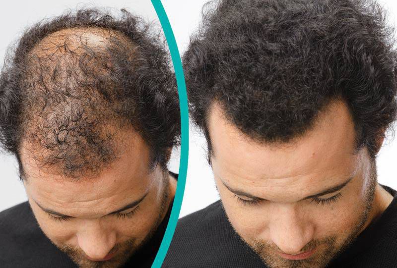 Haarverlängerung männer